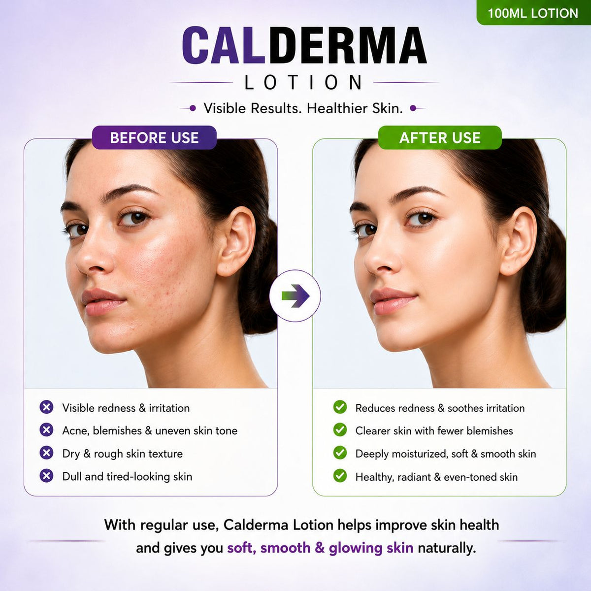 Calderma Lotion
